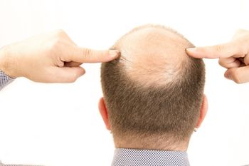 La piel pelada de la cabeza sufre el frío y otras inclemencias aún más que otras zonas del cuerpo 