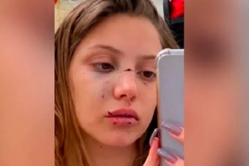 hurlingham: la confundieron con otra chica y la desfiguraron