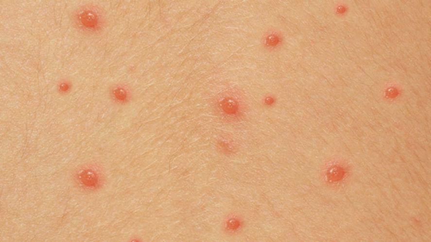 La viruela del mono puso en alerta al mundo
