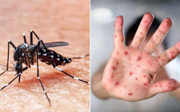 Dos muertes por sarampión y dengue: ¿cómo prevenir el contagio de estas enfermedades?