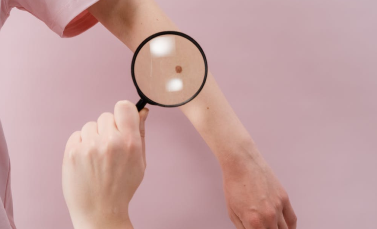 En el Día Mundial del Melanoma: ¿cuáles son las medidas de prevención para una detección temprana?