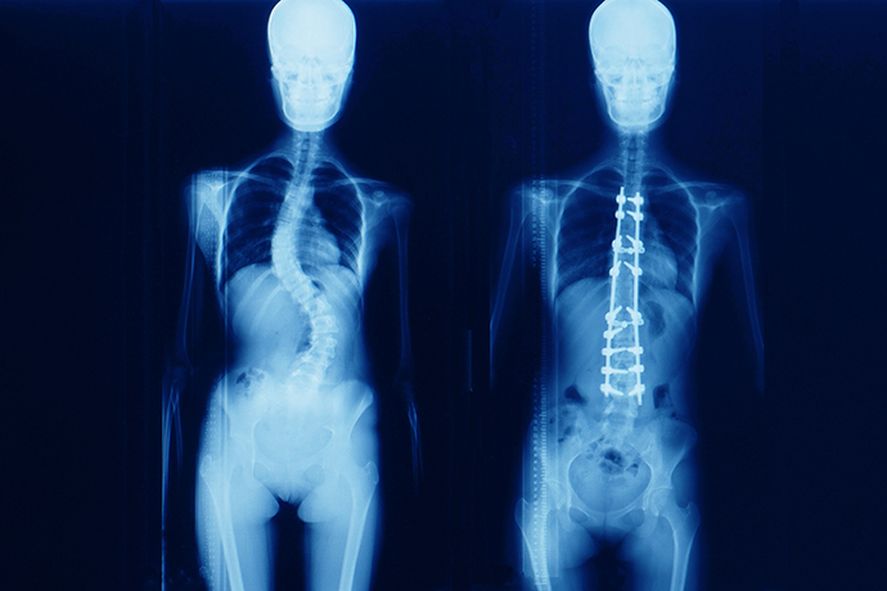 Junio es el mes de concientización de la escoliosis y el Ministerio de Salud bonaerense informó acerca de las señales por las que hay que consultar.