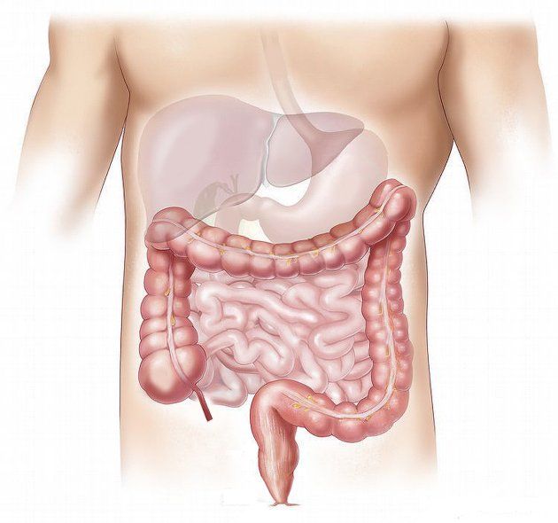 El diagnóstico temprano es clave para prevenir el cáncer de colon (Imagen de Elionas2 en Pixabay)