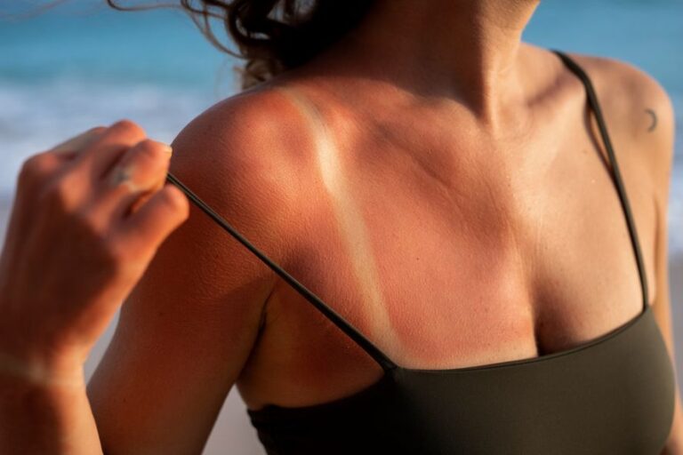 Cuidados de verano: cómo evitar quemaduras del sol y qué hacer si tengo la piel muy roja