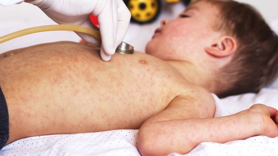 El sarampión es una enfermedad vírica muy contagiosa que afecta sobre todo a niños y niñas