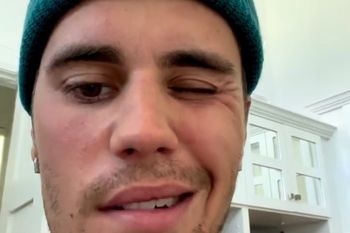 ¿viene a la plata?: sindrome paraliza medio rostro de justin bieber
