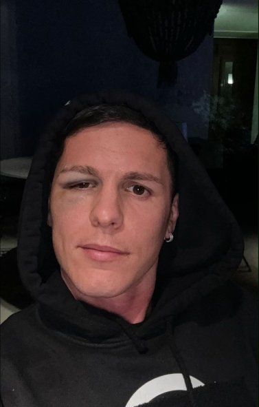 Así quedó Guido Carrillo tras el golpe recibido en la victoria de Estudiantes ante Defensa y Justicia Así quedó Guido Carrillo tras el golpe recibido en la victoria de Estudiantes ante Defensa y Justicia